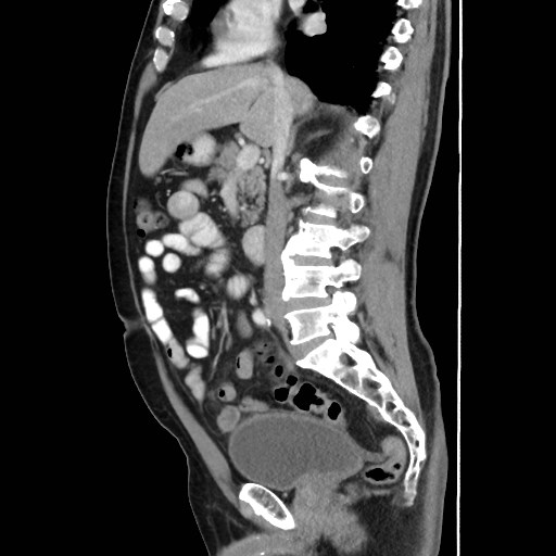 Cecal mass causing appendicitis (Radiopaedia 59207-66531 C 29).jpg