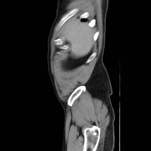 Cecal mass causing appendicitis (Radiopaedia 59207-66531 C 6).jpg