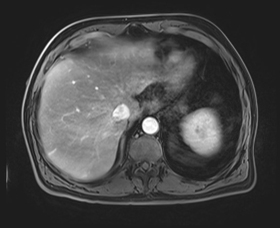 Cecal mass causing appendicitis (Radiopaedia 59207-66532 H 30).jpg