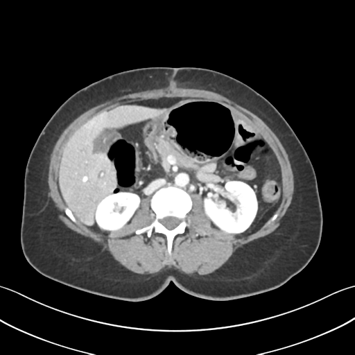 Cecum hernia through the foramen of Winslow (Radiopaedia 46634-51112 A 30).png