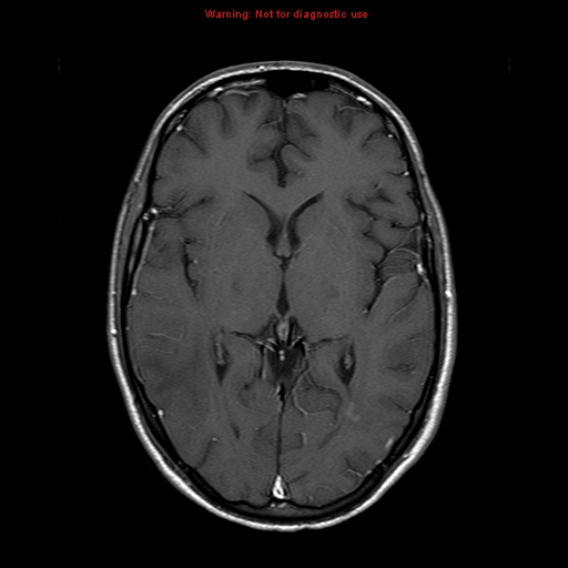 File:Central nervous system vasculitis (Radiopaedia 8410-9235 Axial T1 C+ 12).jpg