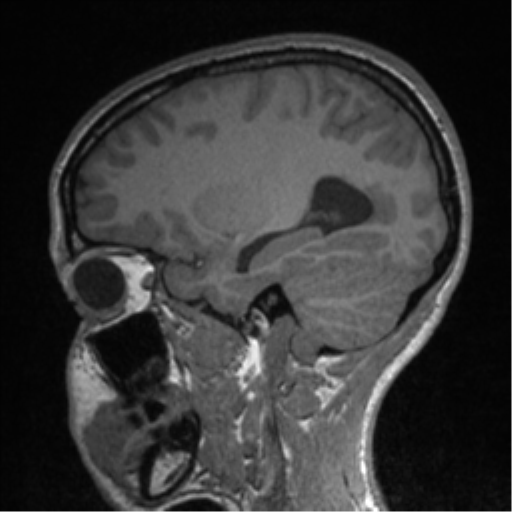Central neurocytoma (Radiopaedia 37664-39557 Sagittal T1 67).png