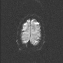 File:Central neurocytoma (Radiopaedia 56690-63469 Axial DWI 38).jpg