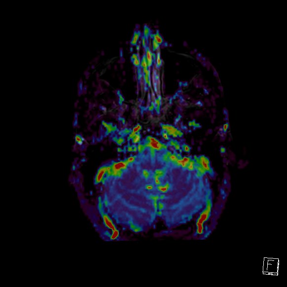 Central neurocytoma (Radiopaedia 84497-99872 Axial Perfusion 266).jpg