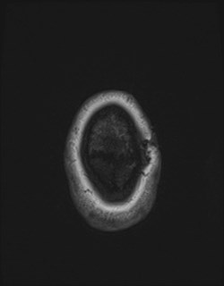 Central neurocytoma (Radiopaedia 84497-99872 Axial T1 178).jpg