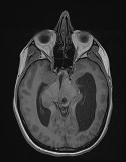 Central neurocytoma (Radiopaedia 84497-99872 Axial T1 84).jpg
