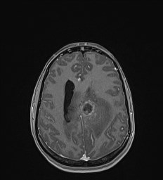 Central neurocytoma (Radiopaedia 84497-99872 Axial T1 C+ 107).jpg