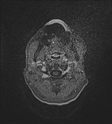 Central neurocytoma (Radiopaedia 84497-99872 Axial T1 C+ 2).jpg
