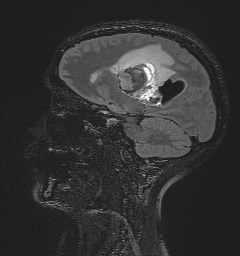 Central neurocytoma (Radiopaedia 84497-99872 Sagittal Flair + Gd 93).jpg