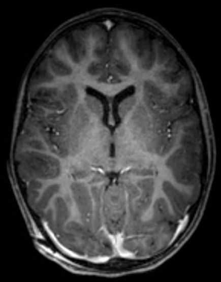 Cerebellar abscess (Radiopaedia 73727-84563 Axial T1 C+ fat sat 62).jpg