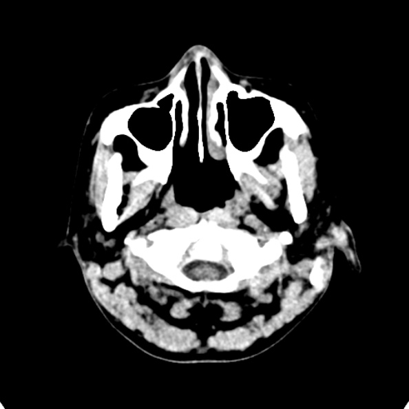 File:Cerebellar abscess secondary to mastoiditis (Radiopaedia 26284-26412 Axial non-contrast 3).jpg