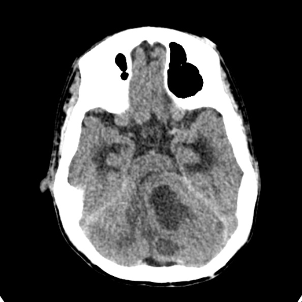 Cerebellar abscess secondary to mastoiditis (Radiopaedia 26284-26412 Axial non-contrast 51).jpg