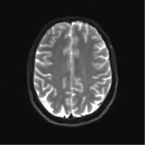 Cerebellar agenesis with hypoplastic pons (pontocerebellar hypoplasia) (Radiopaedia 57224-64138 Axial DWI 27).png