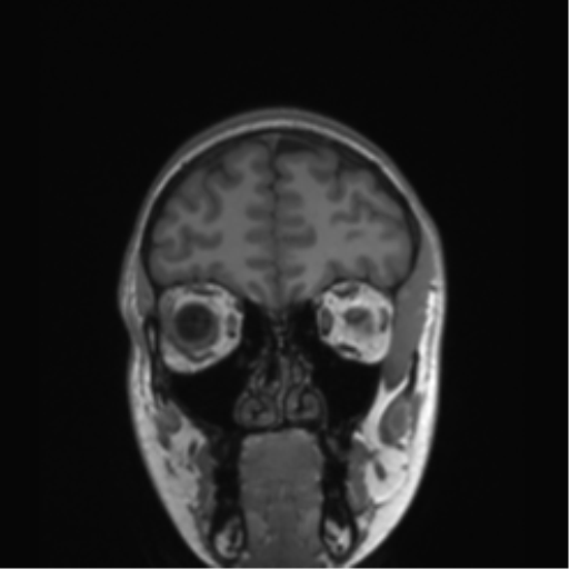 Cerebellar agenesis with hypoplastic pons (pontocerebellar hypoplasia) (Radiopaedia 57224-64138 Coronal T1 76).png