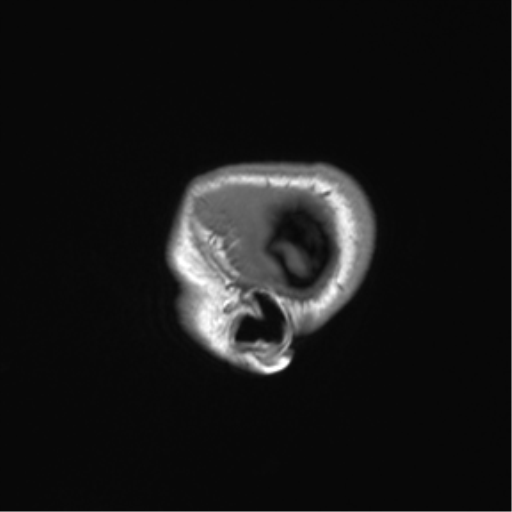Cerebellar agenesis with hypoplastic pons (pontocerebellar hypoplasia) (Radiopaedia 57224-64138 Sagittal T1 11).png