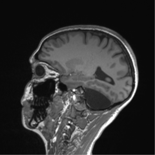 Cerebellar agenesis with hypoplastic pons (pontocerebellar hypoplasia) (Radiopaedia 57224-64138 Sagittal T1 27).png