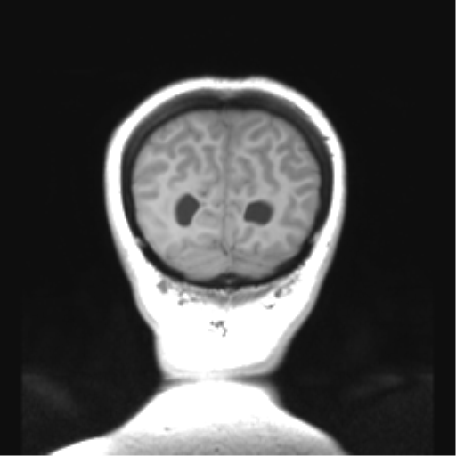 Cerebellar ependymoma complicated by post-operative subdural hematoma (Radiopaedia 83322-97736 Coronal T1 51).png