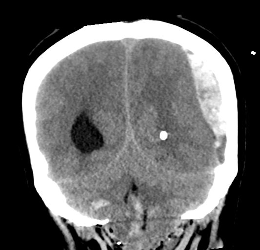 File:Cerebellar ependymoma complicated by post-operative subdural hematoma (Radiopaedia 83322-97737 Coronal non-contrast 29).png
