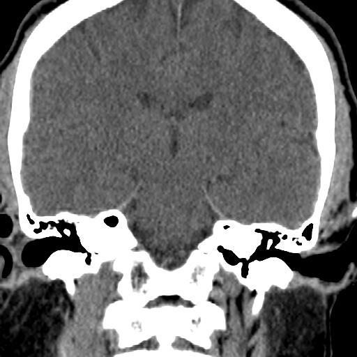 Cerebellar infarction (Radiopaedia 16625-16327 Coronal non-contrast 13).jpg