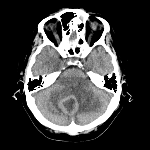 Cerebellar metastasis (Radiopaedia 54578-60812 Axial non-contrast 14).png