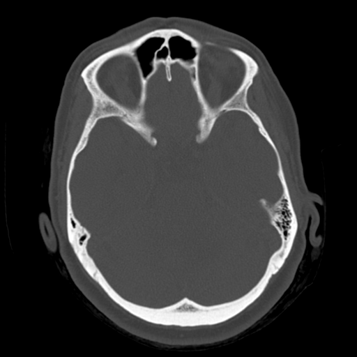 Cerebellar metastasis (cystic appearance) (Radiopaedia 41395-44258 Axial bone window 22).png