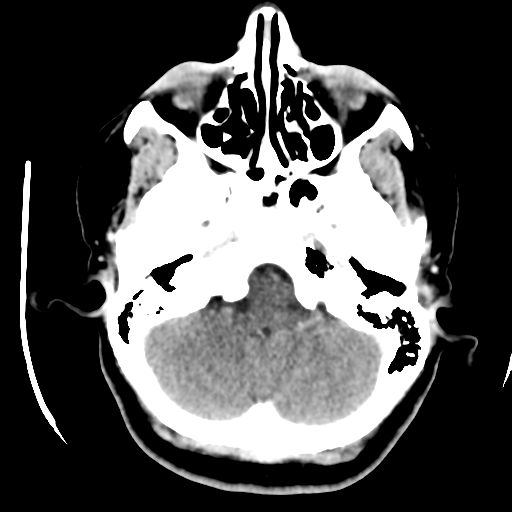 File:Cerebellar metastasis (cystic appearance) (Radiopaedia 41395-44258 B 11).png