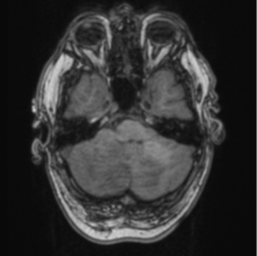 Cerebellar metastasis from lung adenocarcinoma (Radiopaedia 86690-102829 Axial T1 21).png