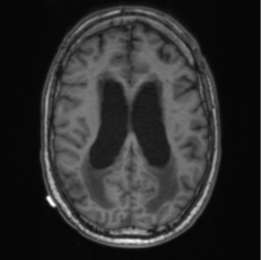 Cerebellar metastasis from lung adenocarcinoma (Radiopaedia 86690-102829 Axial T1 52).png