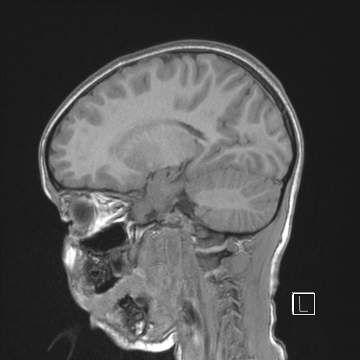Cerebellar stroke (Radiopaedia 32202-33150 Sagittal T1 C+ 33).png