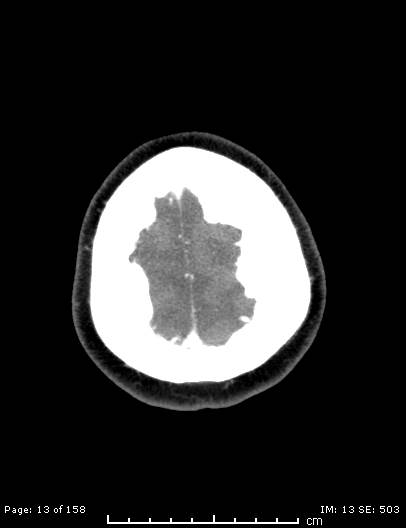 Cerebellar strokes due to intracranial giant cell arteritis (Radiopaedia 68799-78510 CT angiogram 13).jpg
