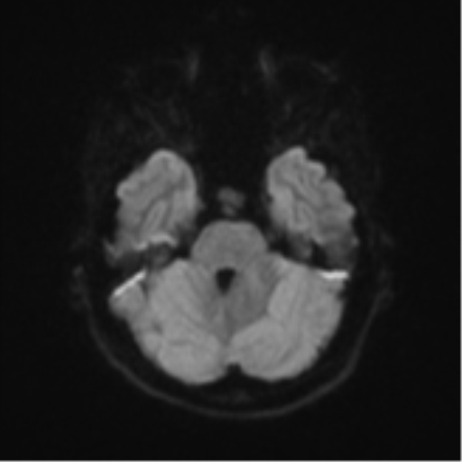 Cerebellar tuberculomas (Radiopaedia 46939-51472 Axial DWI 37).png