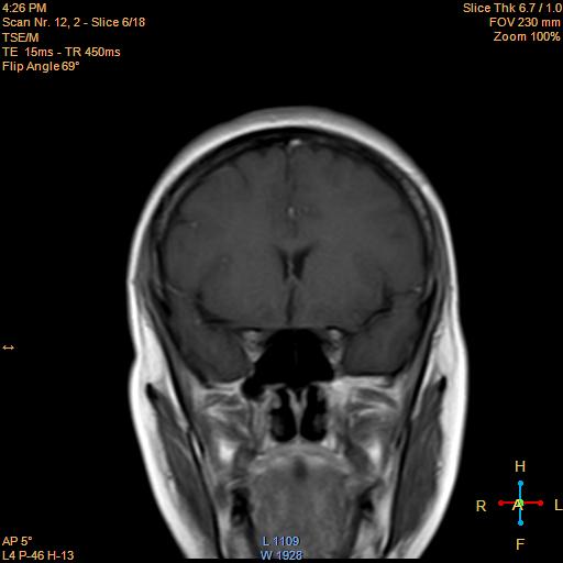 File:Cerebellopontine angle meningioma (Radiopaedia 22488-22525 Coronal T1 C+ 6).jpg