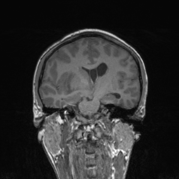 Cerebral abscess (Radiopaedia 24212-24478 Coronal T1 112).jpg