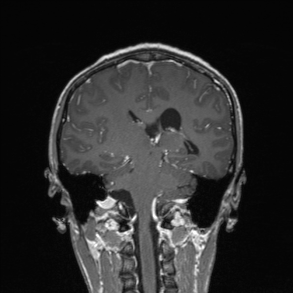 Cerebral abscess (Radiopaedia 24212-24478 Coronal T1 C+ 130).jpg