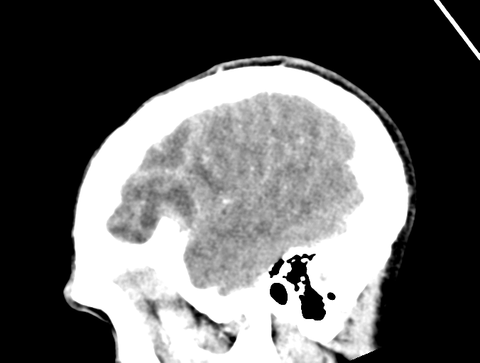 Cerebral abscess (Radiopaedia 60342-68008 Sagittal C+ delayed 43).png