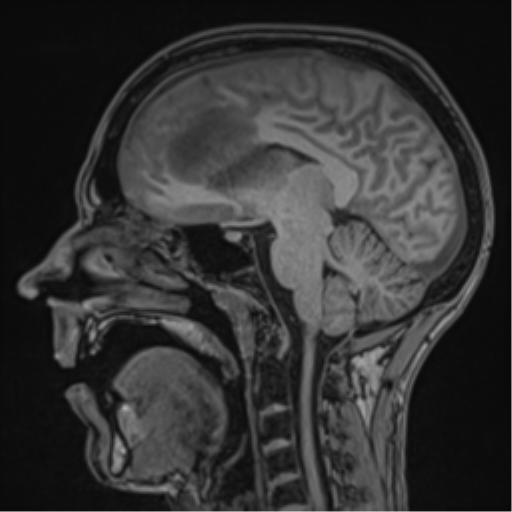 Cerebral abscess (Radiopaedia 60342-68009 Sagittal T1 31).png