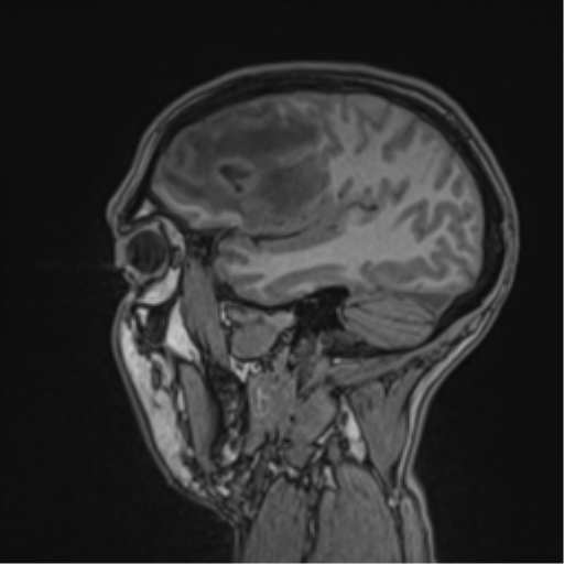 Cerebral abscess (Radiopaedia 60342-68009 Sagittal T1 43).png
