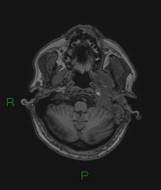 File:Cerebral abscess and subdural empyema (Radiopaedia 84436-99779 Axial T1 72).jpg