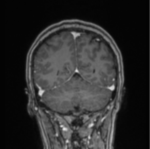 File:Cerebral abscess from pulmonary arteriovenous malformation (Radiopaedia 86275-102291 L 26).png