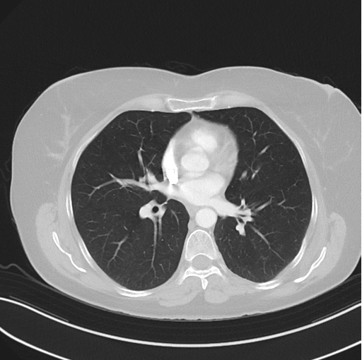 Cerebral abscess from pulmonary arteriovenous malformation (Radiopaedia 86275-102292 Axial lung window 32).png