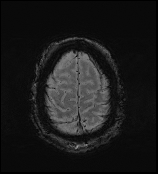 Cerebral abscess with ventriculitis (Radiopaedia 78965-91878 Axial SWI 46).jpg