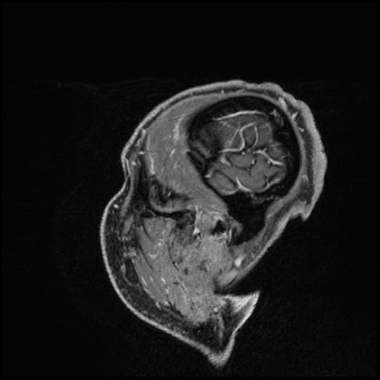 Cerebral abscess with ventriculitis (Radiopaedia 78965-91878 Sagittal T1 C+ 164).jpg
