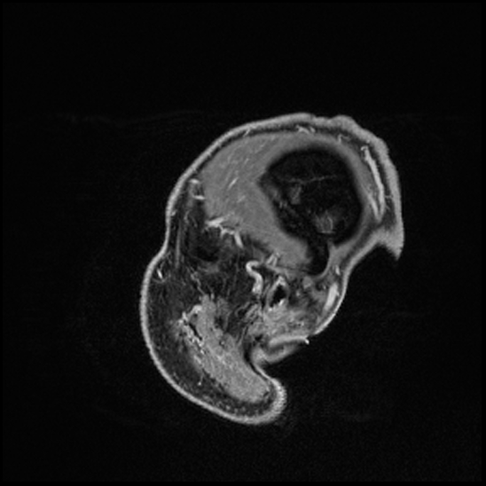 Cerebral abscess with ventriculitis (Radiopaedia 78965-91878 Sagittal T1 C+ 169).jpg