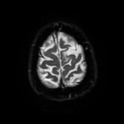 Cerebral amyloid angiopathy (Radiopaedia 28698-28978 Axial DWI 55).jpg