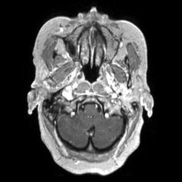Cerebral amyloid angiopathy (Radiopaedia 29129-29518 Axial T1 C+ 23).jpg
