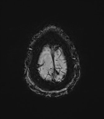 File:Cerebral amyloid angiopathy (Radiopaedia 46082-50433 Axial SWI 82).png