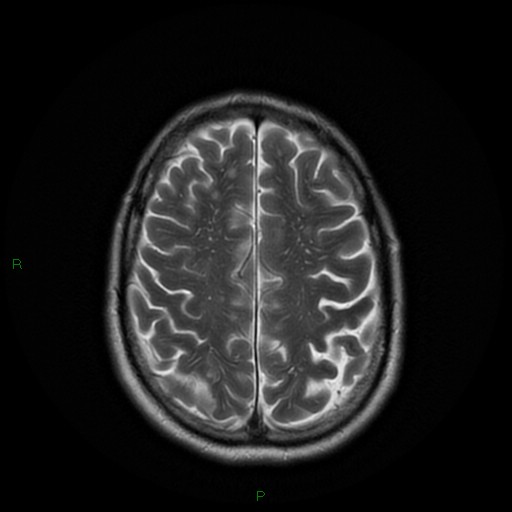 File:Cerebral amyloid angiopathy (Radiopaedia 77506-89664 Axial T2 22).jpg