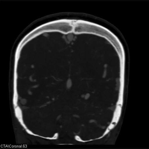 Cerebral arteriovenous malformation (Radiopaedia 28518-28759 C 63).jpg