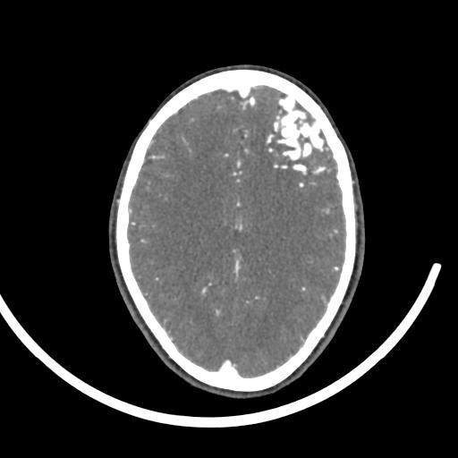 Cerebral arteriovenous malformation (Radiopaedia 29531-30031 E 70).jpg