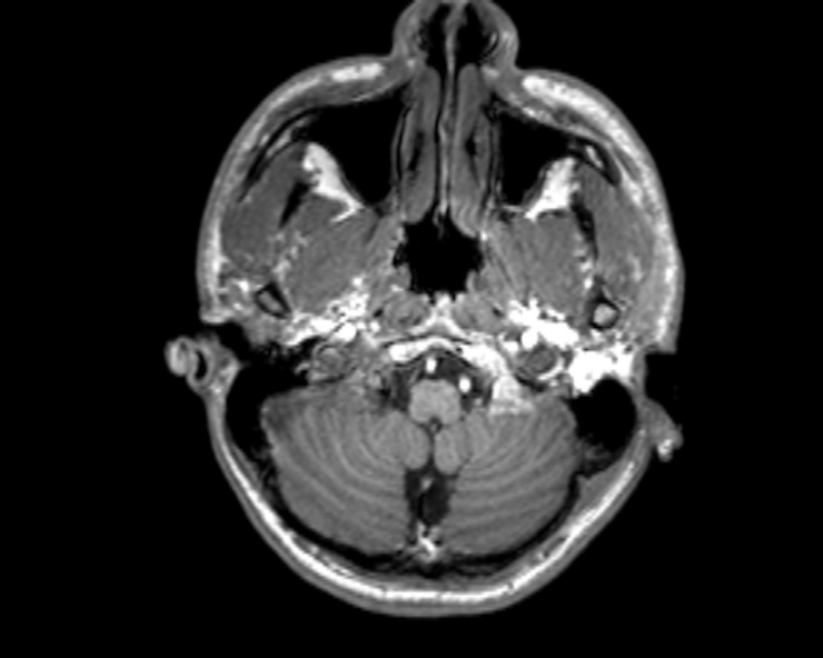 Cerebral arteriovenous malformation (Radiopaedia 30198-30813 Axial T1 49).jpg